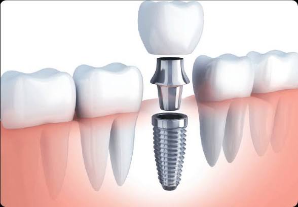 Rehabilitación oral e implantología